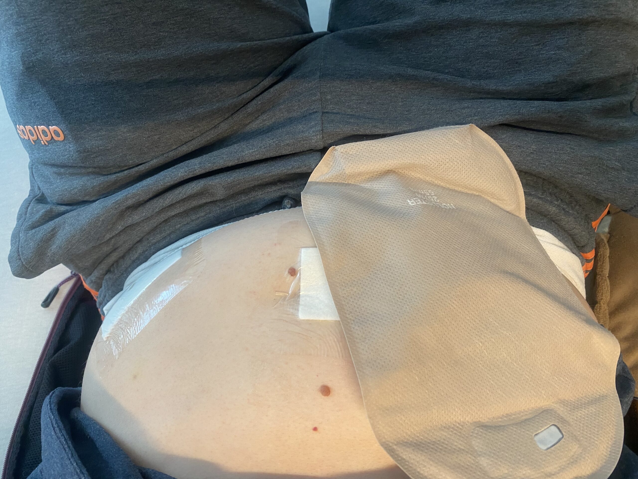 Mein Bauch nach der Operation